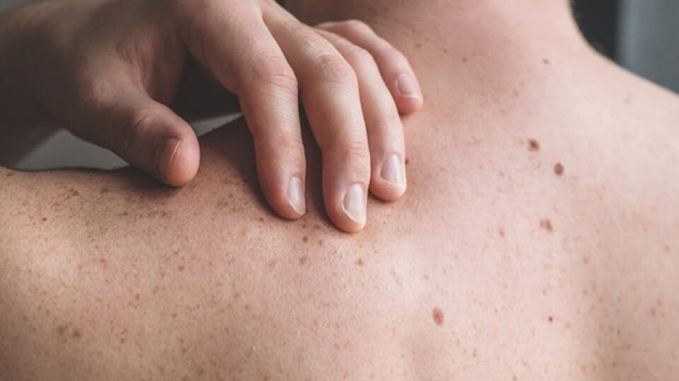 La provincia recuerda la importancia de sostener cuidados del sol en el Día Mundial del Melanoma